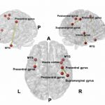 La acupuntura en el dolor de Pacientes con Parkinson