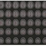 Acupuntura Craneal potencia la Conectividad funcional de las redes funcionales visual y cognitiva-motoras en pacientes con ictus isquémicoa agudo (Liu, H et al, 2020)