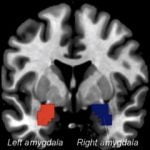 Los efectos inmediatos de la estimulación transcutánea continua auricular del nervio vago (taVNS) en puntos de acupuntura sobre la conectividad funcional de la amígdala en Migraña sin aura (MsA): un estudio preliminar (Luo, W et al 2020).