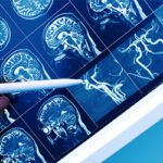 Acupuntura para la alteración cognitiva post-ictus: una revisión sistemática y meta-analisis. (Kuang, X et al. Acupunct Med. 2021)