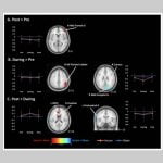Acupuntura y los cambios en la conectividad funcional en la Dismenorrea Primaria: un estudio de RMI funcional en estado de reposo.