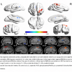 Efectos neuronales de la terapia de estimulación eléctrica de baja frecuencia en puntos de acupuntura en pacientes con disfunción motora postictus: un estudio de resonancia magnética funcional en reposo (Li D et al. Arch Rehabil Res Clin Transl. 2025)
