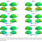 Cambios inmediatos en el flujo sanguíneo cerebral y la conectividad funcional tras la acupuntura intradérmica en el trastorno depresivo mayor (Yu Z et al. Front Neurosci. 2026)