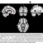 Efectos de la acupuntura sobre la función cerebral en pacientes con depresión: metaanálisis de estudios de resonancia magnética funcional (Zhang J et al. Medicine (Baltimore). 2026)